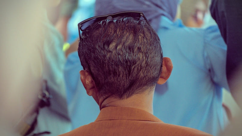 Breaking Barriers How Long Hair FUE  Surgery is Revolutionizing Hair Restoration